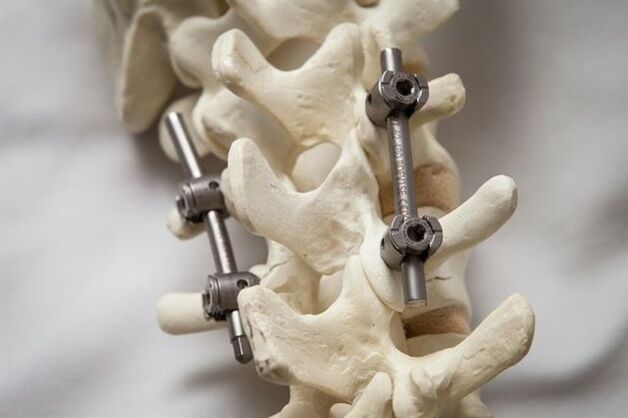 Fixierung der Wirbelsäule Osteochondrose des Halses