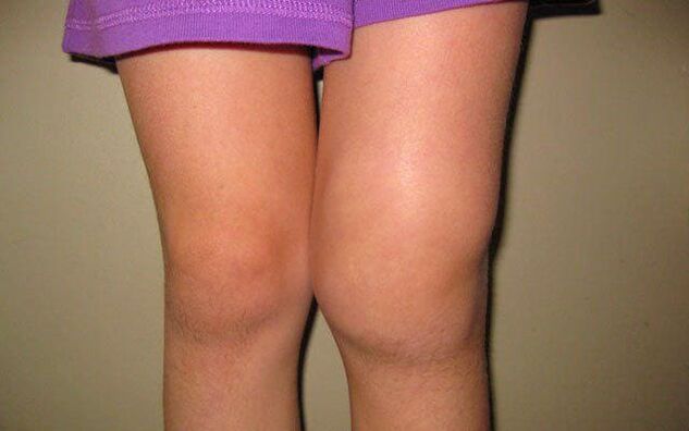 geschwollenes Knie durch Arthrose