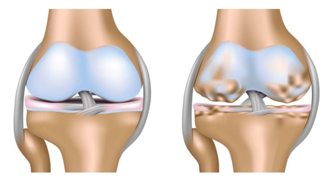 gesunder Knorpel und Schädigung des Kniegelenks bei Arthrose