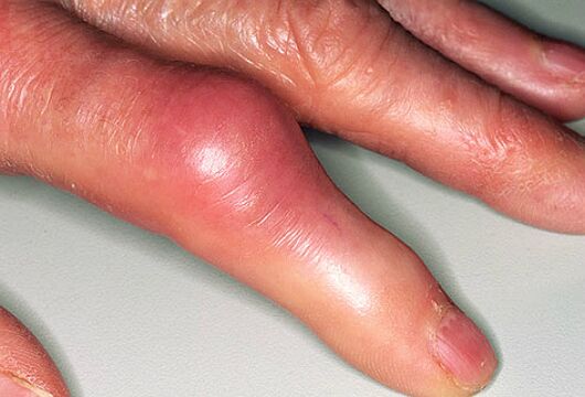 Gicht wird von starken Schmerzen in den Fingern und Schwellungen der Gelenke begleitet. 