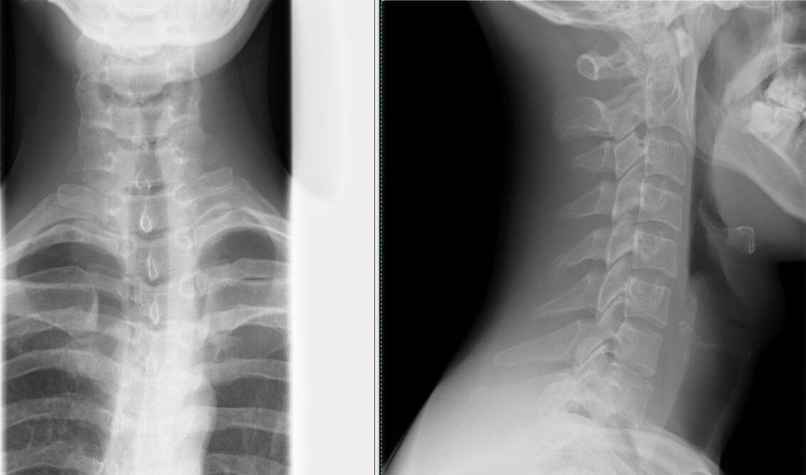 Das Röntgen der Wirbelsäule ist eine einfache und wirksame Methode zur Diagnose von Osteochondrose