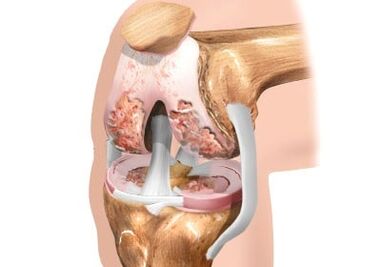 Schädigung der Arthrose des Kniegelenks