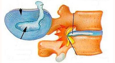 Merkmale der Entwicklung von Hals -Osteochondose