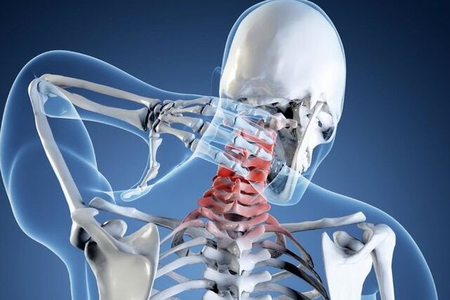 Osteochondrose der Halswirbelsäule